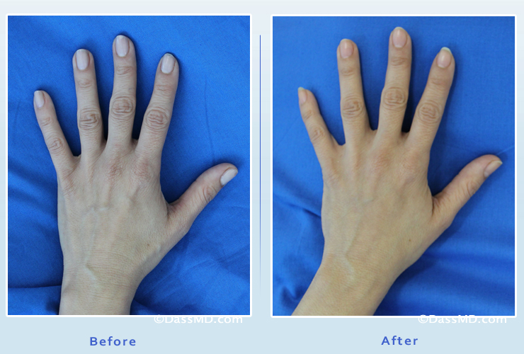 Hand Rejuvenation Results Beverly Hills - Before and After ...
