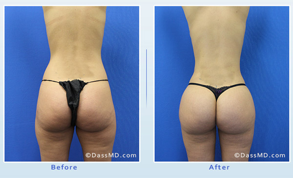 What are the average results for thigh liposuction?