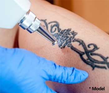 Tattoo Removal Near Me Beverly Hills - Is Tattoo Removal ...