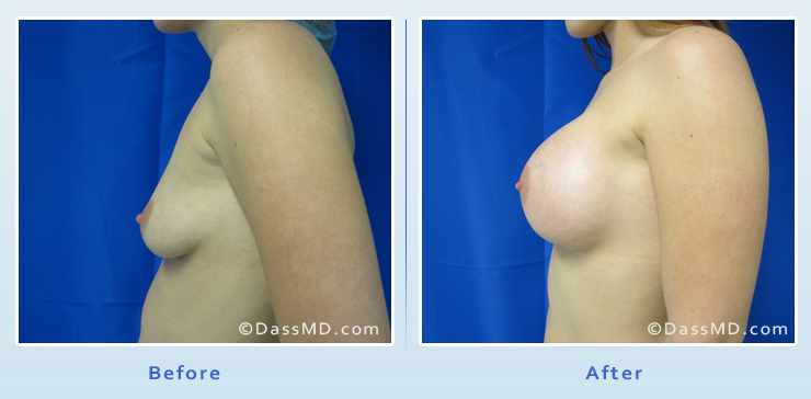 Best Breast Augmentation Results! Beverly Hills Plastic Surgeon A Cup to Double  D from nude 34 size boobs Watch Video 