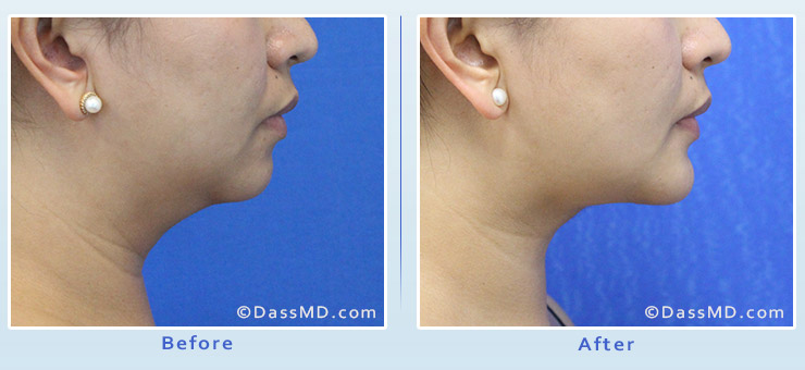 Chin Augmentation with Chin Implant Beverly Hills - Before and After image 01