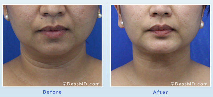 Chin Augmentation with Chin Implant Beverly Hills - Before and After image 03