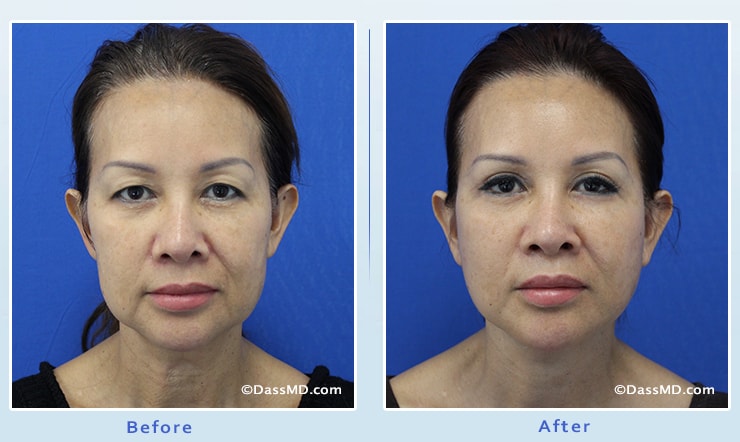 Beverly Hills Facelift and Facial Fat Grafting Before and After Photos