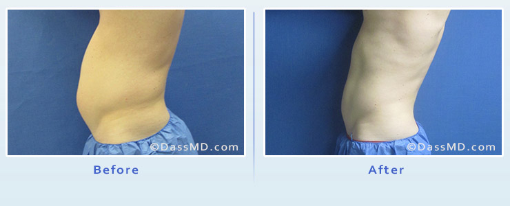 Beverly Hills Male Liposuction Results - After View