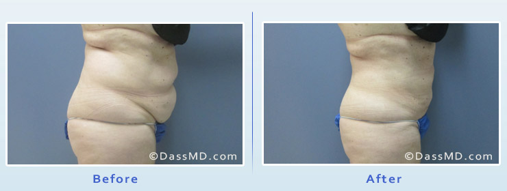 Dr. Dennis Dass, MD Liposuction by body area