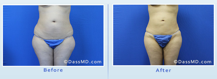 Beverly Hills Liposuction of the Flanks Results - After View