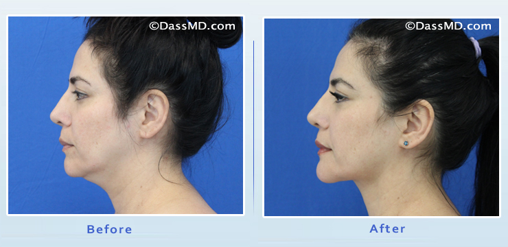 Beverly Hills Liposuction of the neck and chin Results - After View