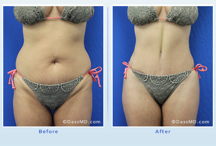 Beverly Hills Tummy Tuck Results - After View