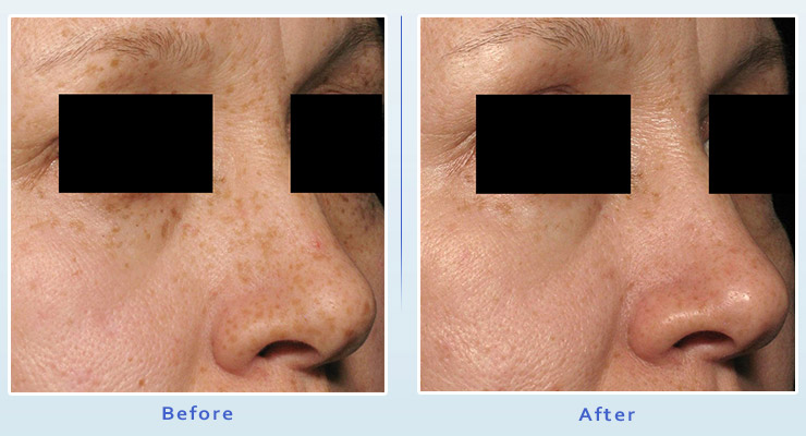 Treatment Of Melasma With Picosure In Beverly Hills Laser Facial