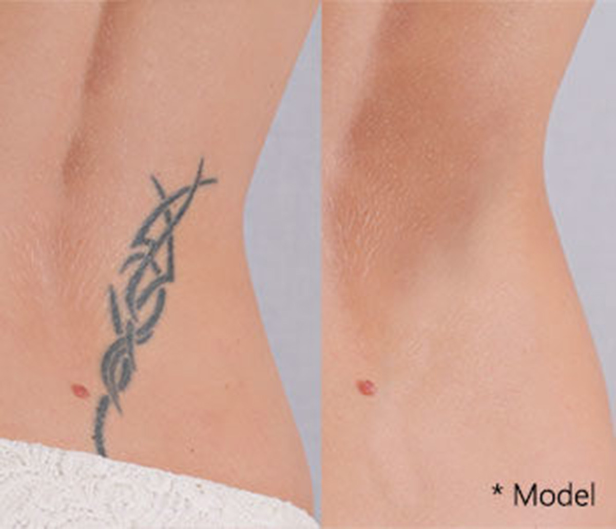 PicoSure tattoo removal near Beverly Hills