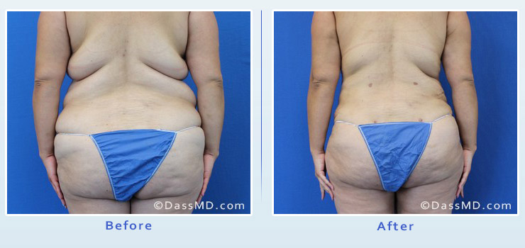 Beverly Hills extreme transformation case 1 before after image 5
