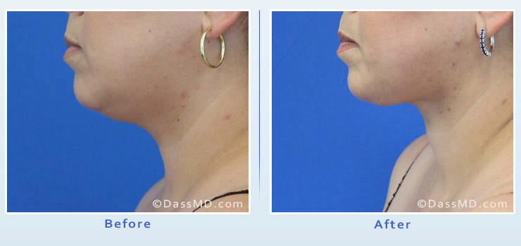 Beverly Hills extreme transformation case 2 before after image