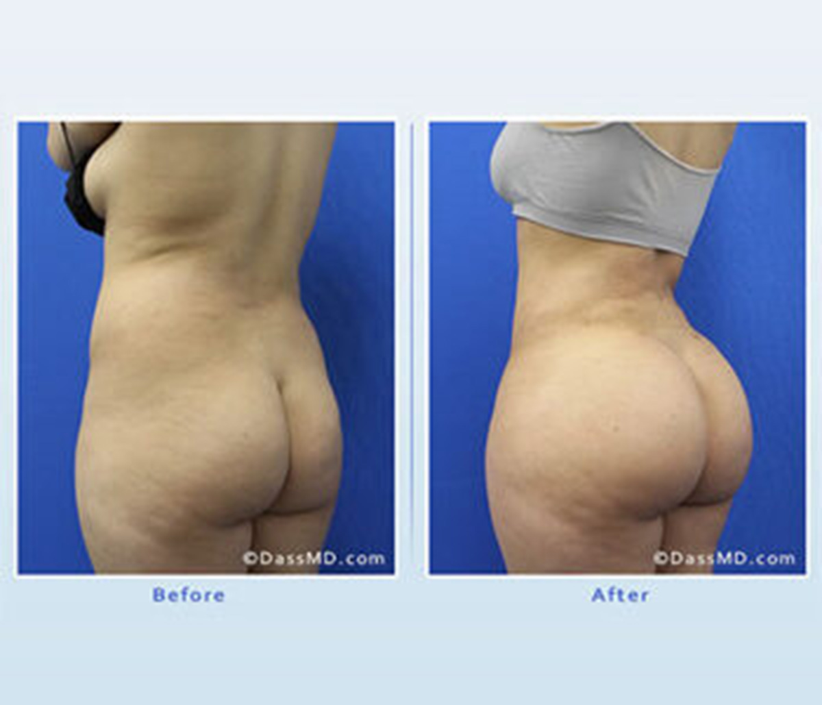 Brazilian butt lift surgery helps patients achieve a shapelier body with curves
