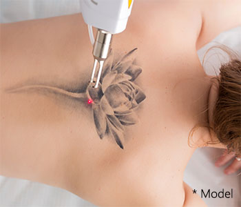 Does Picosure laser tattoo removal hurt - Beverly Hills, CA