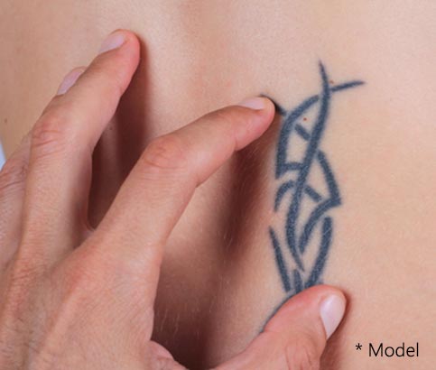 Dr. Dennis Dass offers tattoo removal using the advanced Picosure laser.