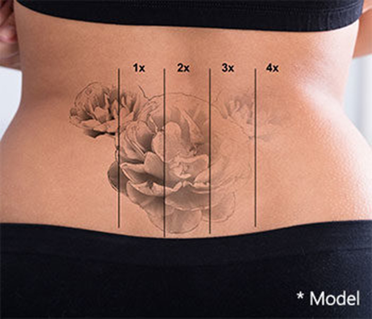 Effective laser tattoo removal in Los Angeles and Beverly Hills