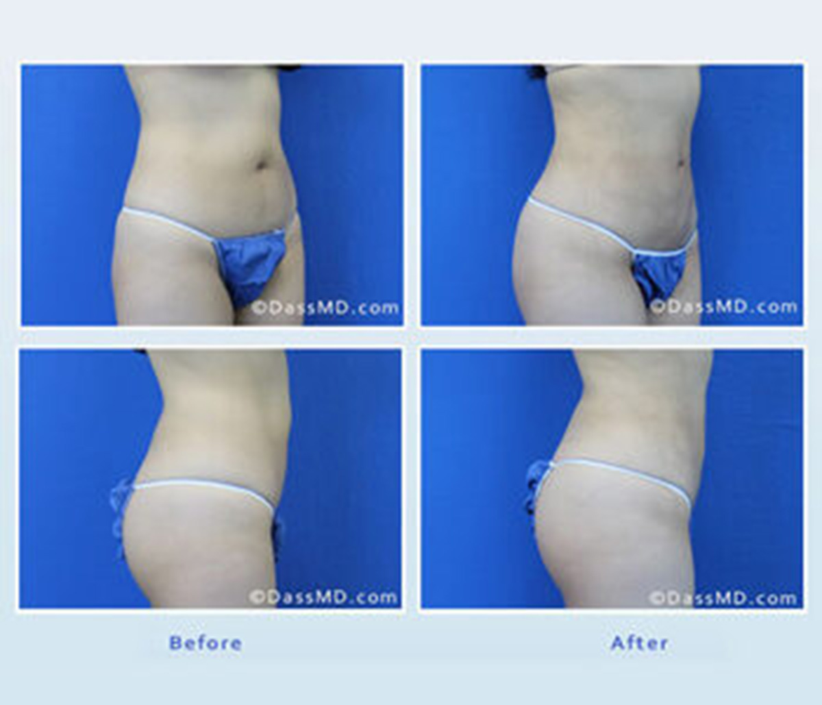 Dr. Dennis Dass in Beverly Hills explains recovery and results for liposuction surgery