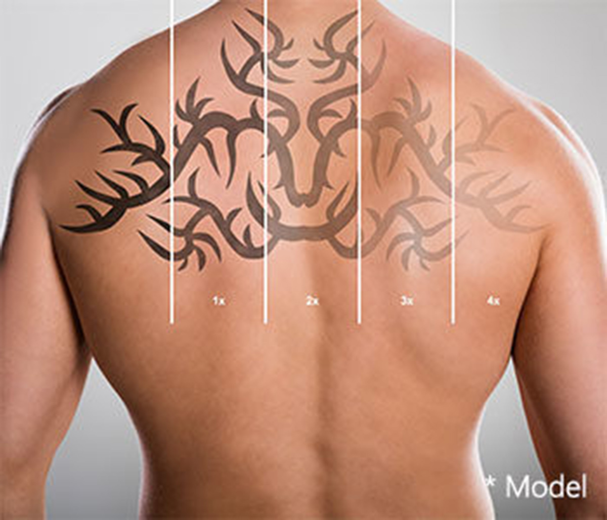 Plastic surgeon offers laser tattoo removal near Beverly Hills