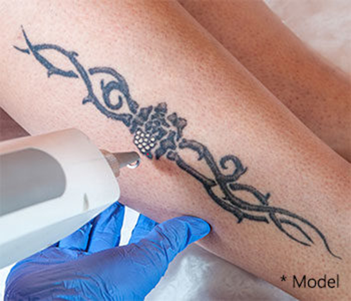 Learn more about tattoo removal in Beverly Hills