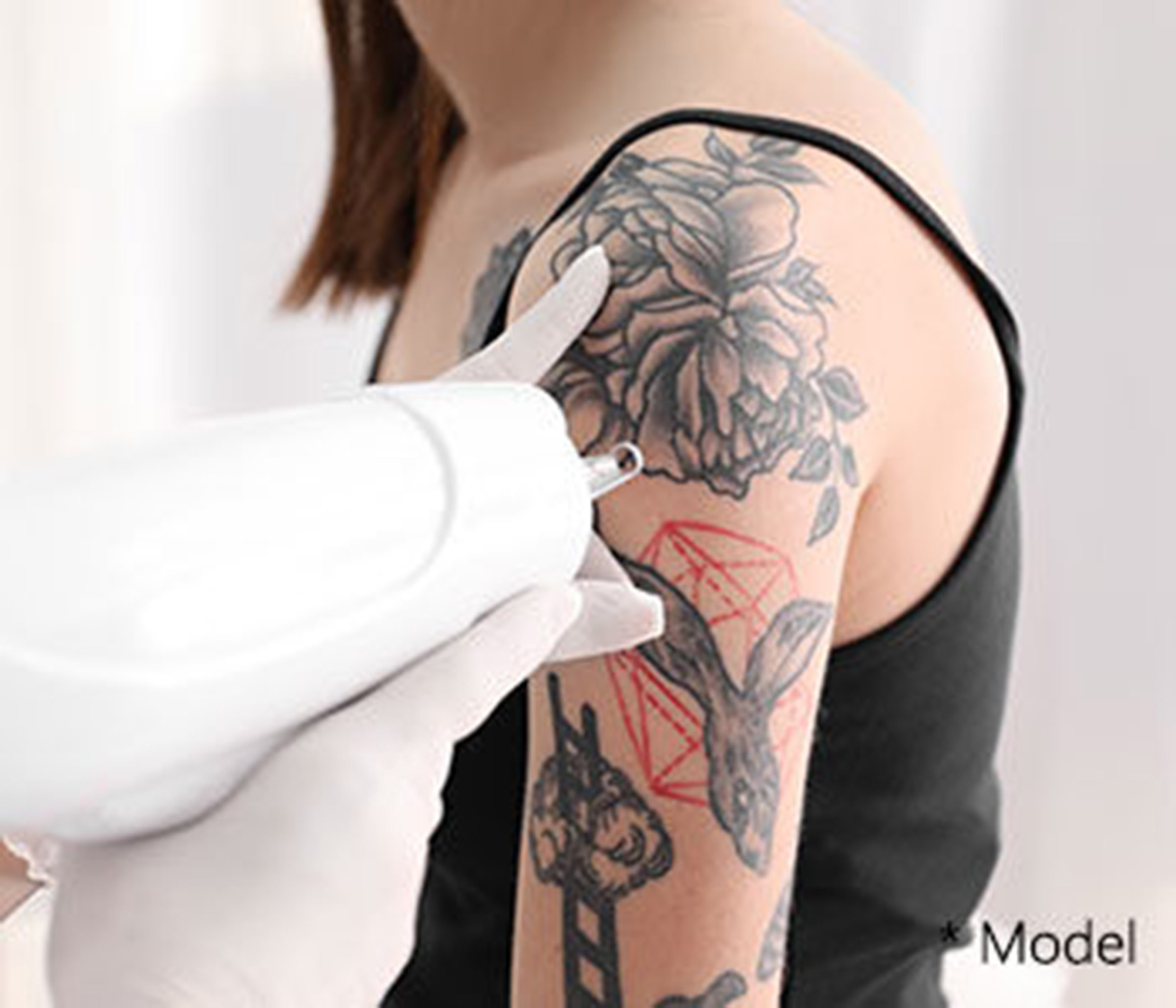 Say goodbye to ink with tattoo removal near Beverly Hills
