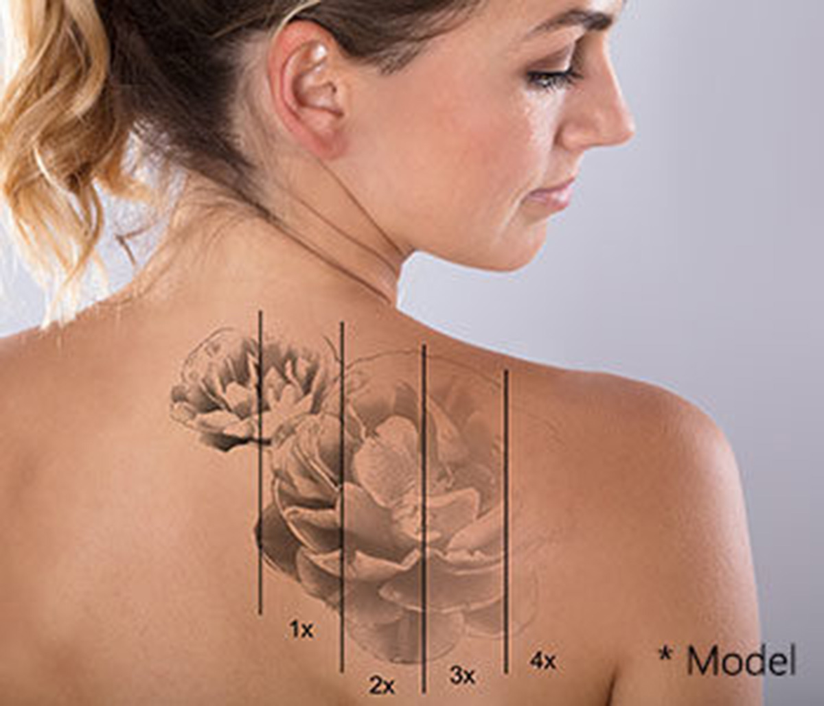 Is tattoo removal successful in Beverly Hills