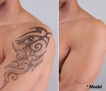 Tattoo Removal Near Me Beverly Hills - Is Tattoo Removal Successful
