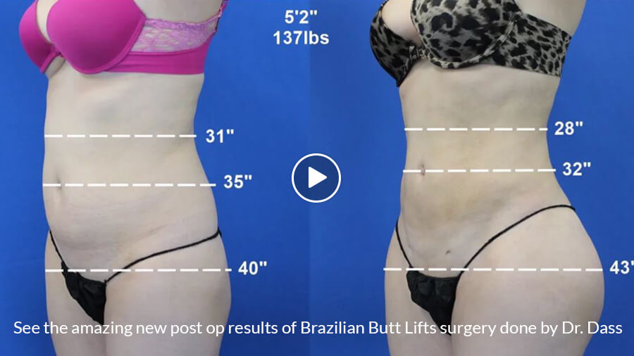 Brazilian Butt Lift Beverly Hills - Buttock Augmentation - Butt Reshaping
