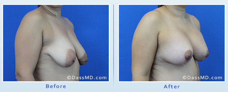 Breast Reduction case 1 before after image 2