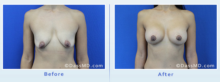 Breast Reduction case 2 before after image 1