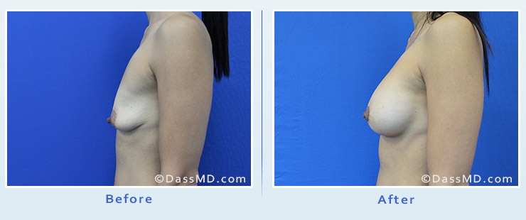 Breast Reduction case 2 before after image 3