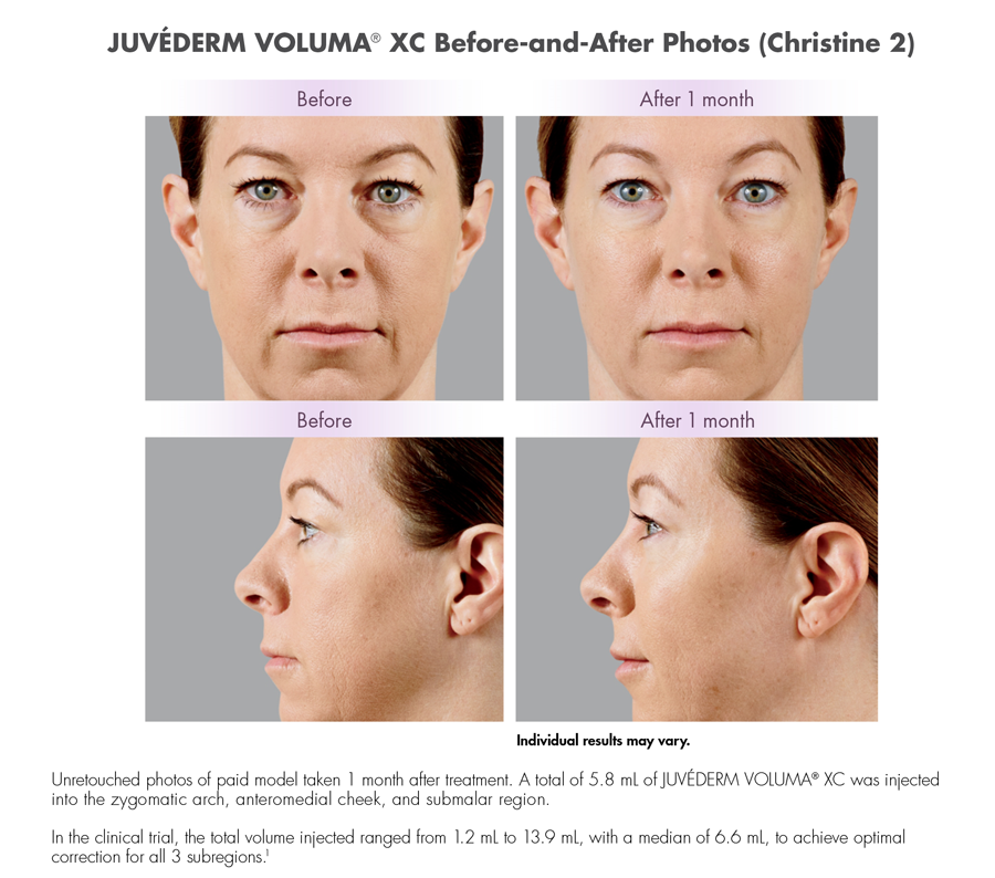 Juvederm Voluma Beverly Hills Cheek Augmentation Sagging Skin