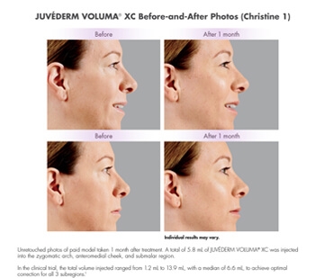 Juvederm before after image 2