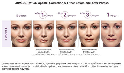 Juvederm Ultra Plus XC before after image 2