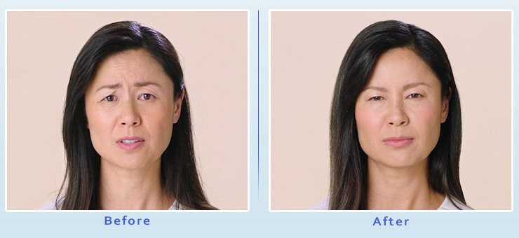 Beverly Hills Botox Results - After View