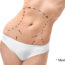 Learn more about the high-definition liposuction technique