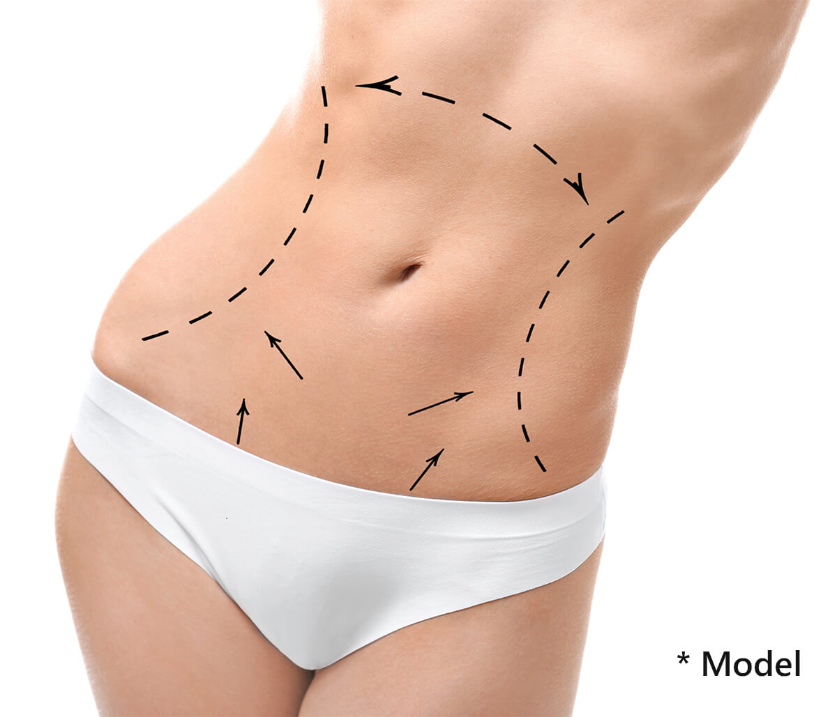 High Definition Liposuction in Beverly Hills Area